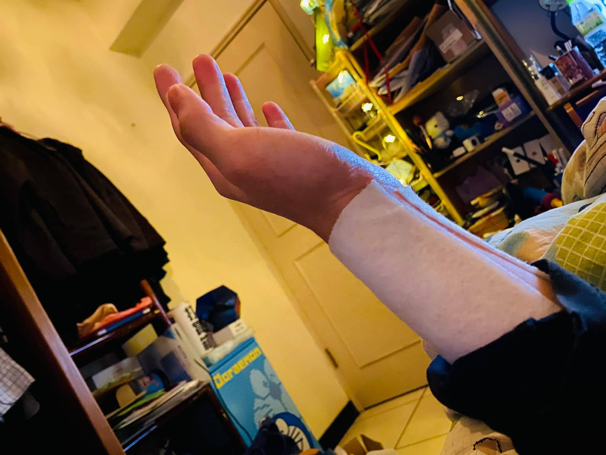 連續折氣球後,手腕貼著白色貼布